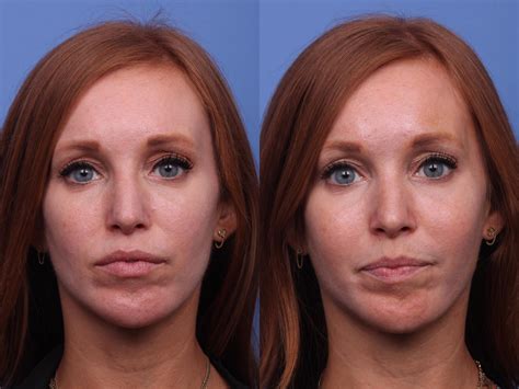 Plastic Surgery Before and After Photo Gallery 